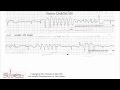 ECG Interpretation, Advanced Level - Part 9 ECG Interpretation, Advanced Level - Part 9