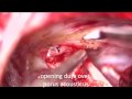 Retrosigmoid craniotomy