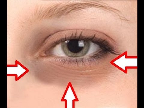how to remove eye bags