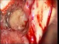 Brain tumors-colloid cyst 3rd ventricle-microsurgery-dr suresh dugani/HUBLI/INDIA