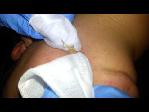 how to drain a cyst