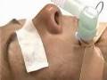Breast Reduction Surgery