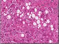 Medical School Pathology, Chapter 9d