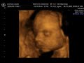 4D baby scan of our son Lake