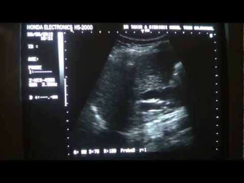 how to locate cbd on ultrasound
