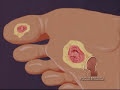 Type 2 Diabetes