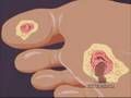Type 2 Diabetes