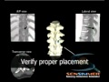 Simulator-Guided Location Of The Thoracic Pedicle Screw Simulator-Guided Location Of The Thoracic Pedicle Screw