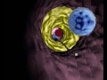 Artherosclerosis - animation on inserting a stent
