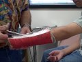 My Cast Coming Off