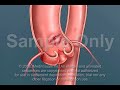 Aortic Dissection