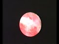 hysteroscopic-treatment-of-osteoid-metaplasia.html