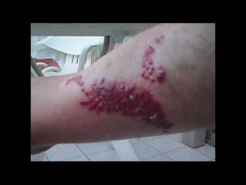 how to relieve pain from jellyfish sting