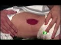 Man Shares Personal Experience With Superbug