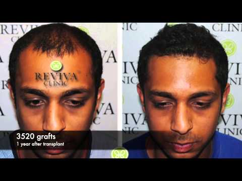 how to hair transplant in india