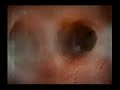 Quit Smoking Campaign - Tumour