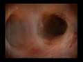 Quit Smoking Campaign - Tumour
