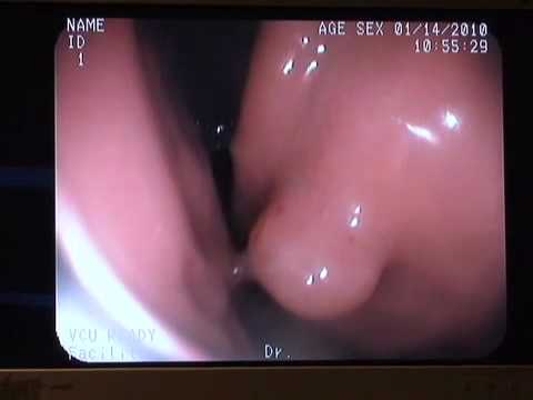 Endoscopy - This video explains how an Upper Endoscopy is done with the BMI of Texas doctors. Visit our website at www.bmioftexas.com for more information or call us at ...