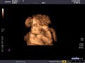Julieta Graff en 4 D (23 semanas) Julieta Graff en 4 D (23 semanas)