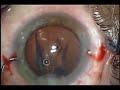 Los Angeles ICL Visian Implantable Contact Lens Uday Devgan