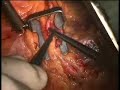 beating heart surgery