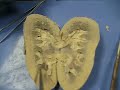 Liver Dissection