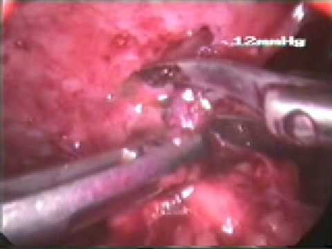 how to repair abdominal fascia