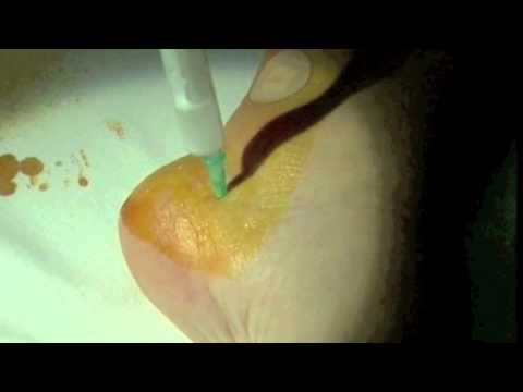 Inifltracion espolon calcaneo. Calcaneal spur infiltration