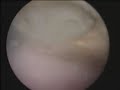 Calcifying tendinitis Calcific tendinitis Calcium ?????????? ??????????????? ???????
