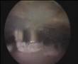 Calcifying tendinitis Calcific tendinitis Calcium ปวดหัวไหล่ ผ่าตัดส่องกล้อง หัวไหล่