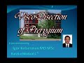 Viscodisection of the pterygium by Igor Kaiserman MD MSc