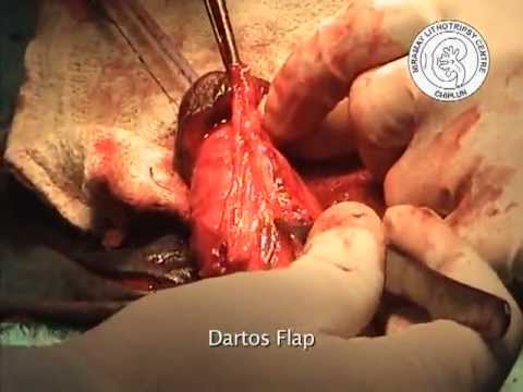 Urethroplasty For A Rare Case Of Traumatic Adult Hypospadias
