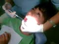 Extra��o de Dente meO irm�o