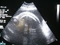 ultrasound with baby 3