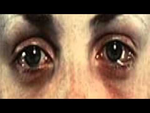 how to relieve runny eyes