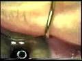 My LASIK Surgery