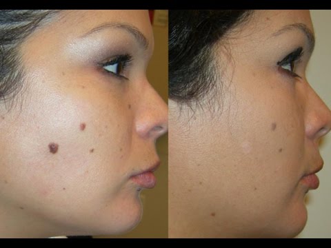 how to remove ez tag