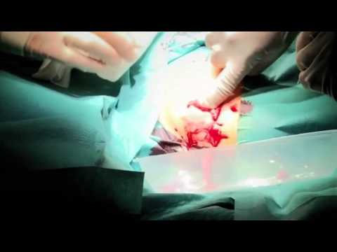 Unusual - Katherine Cross goes under the knife as the surgeons attempt to remove the horrendous abscess on her chest. Check out more Bizarre ER at: http://www.youtube....