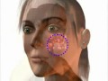 What is acne? - Acne formation process