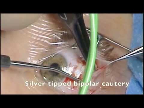 how to cure squint eye without surgery