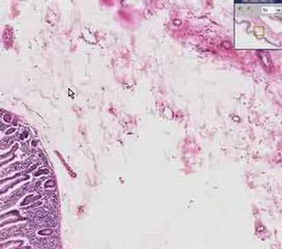 Histopathology Small intestine --Edema