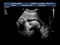 33 Week Ultrasound Scan