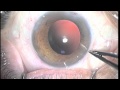 Multifocal IOL Intraocular Lens Human Optics Diffractiva, Cataract Surgery in Guayaquil, Ecuador