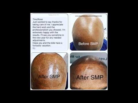 Scalp Micropigmentation And Tricopigmentation Training Now Available In Canada At The Scalp Micropigmentation Center Of …