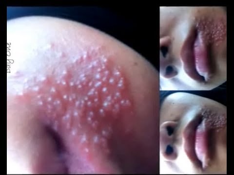 how to treat of cold sores