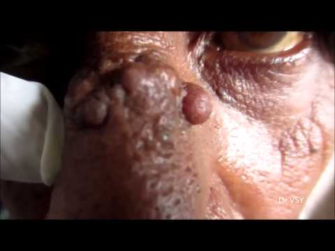 how to treat leukoplakia