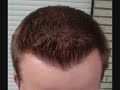 Haartransplantation bei Dr. Heitmann