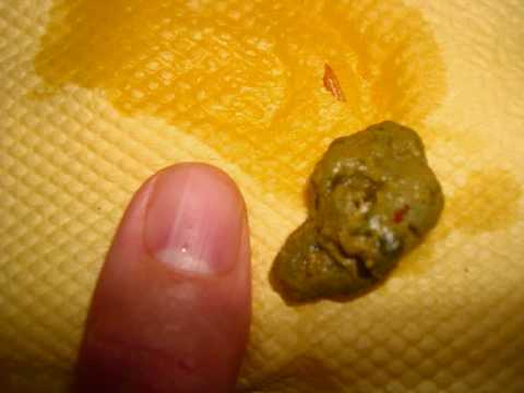 how to get rid gallstones naturally