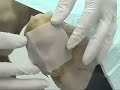 Application of Maggots to Wound