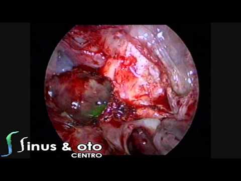 how to identify csf leak
